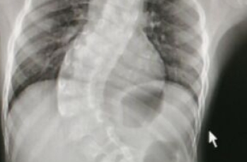 全脊柱动态DR实现无拼接全脊柱成像  