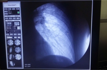X-RAY如何检测IGBT？